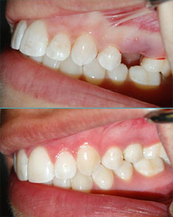 Dental Implant: before and after