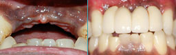Dental Implant images